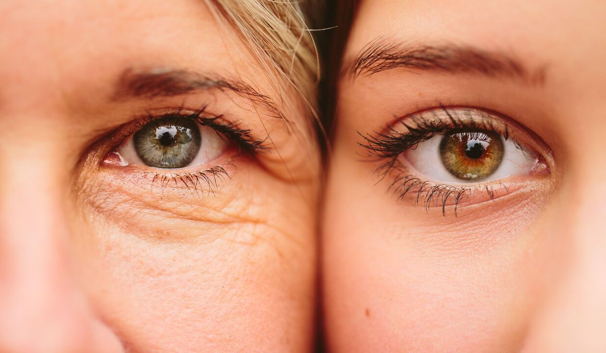 آنکھوں کے ارد گرد عمر بڑھنے کی علامات