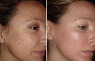 فوٹو سے پہلے اور بعد میں لیزر چہرے کی جلد کی بحالی